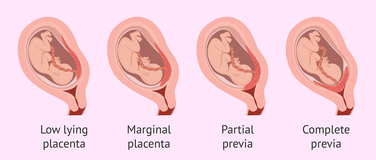 انواع جفت جنین در بارداری